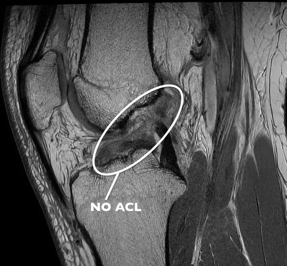 ACL 损伤 MRI 影像示意
