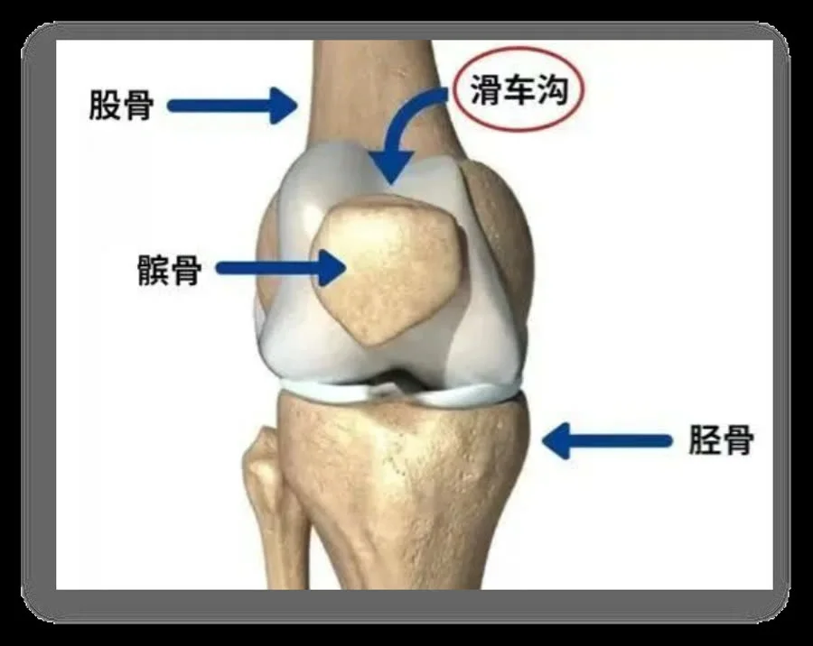 髌骨在膝关节滑车沟中的位置示意